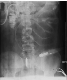 Fig. 4. Intraoperative cholangiogram shows no remaining stone and passage disturbance.