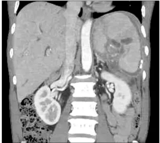 Fig. 2. Abdominal  CT  demonstrates  an  almost  resolved  splenic  subcapsular  pseudocyst,  3  weeks  after  percutaneous  drainage.