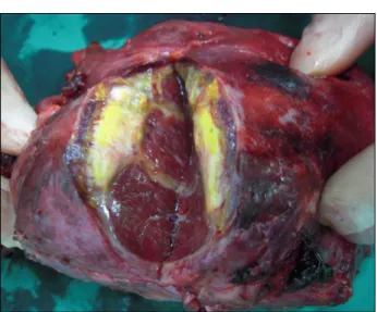 Fig.  3.  Gross  findings  of  the  spleen.  Large  splenic  subcapsular  pseudocyst  was  almost  resolved  and  replaced  to  the   in-flammatory  debris  and  granulation  tissue.