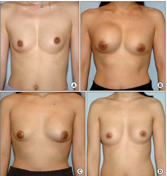 Fig.  1.  Various  symptoms  with  rup- rup-tured  hydrogel  implant.  (A)  No  visible  enlargement,  (B)  Swelling  in  ruptured  side,  (C)  Deflation  in  ruptured  side,  (D)  Change  in  texure  (softness)  in  ruptured  side.