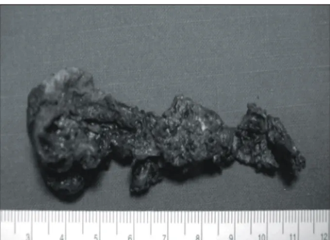 Fig.  3.  A  foreing  body  removed  by  operation,  The  length  is  about  8  cm  length.