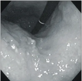 Fig.  1.  Endoscopic  finding.  Endoscopy  shows  irregular  marginated  4×3  cm  early  gastric  cancer  from  high  body  to  mid  body  in  the  anterior  wall  of  stomach.