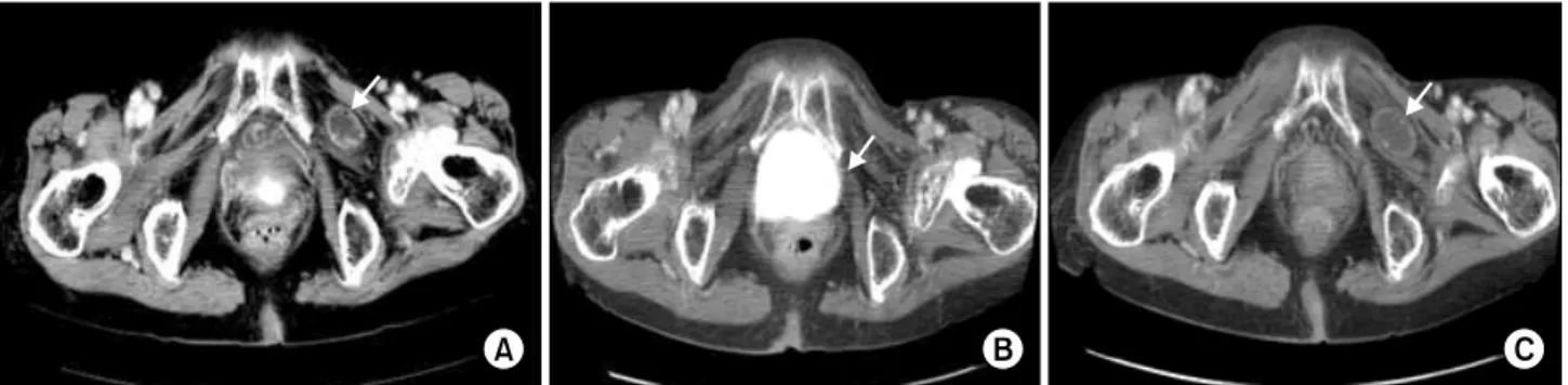 Fig.  2.  Abdominal  and  pelvic  CT  scans  of  Case  1  in  time  series.  (A)  A  small  bowel  segment  is  herniated  through  the  left  obturator  foramen  between  pectineus  and  obturator  externus  muscle  (arrow)