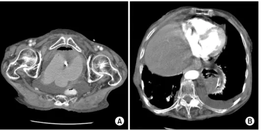 Fig.  5.  Abdominal  and  pelvic  CT  scan  of  Case  2.  (A)  There  is  ascetic  fluid  collection  in  the  pelvic  cavity  and  a  right-sided  obturator  hernia  containing  small  bowel  segment  (arrow)