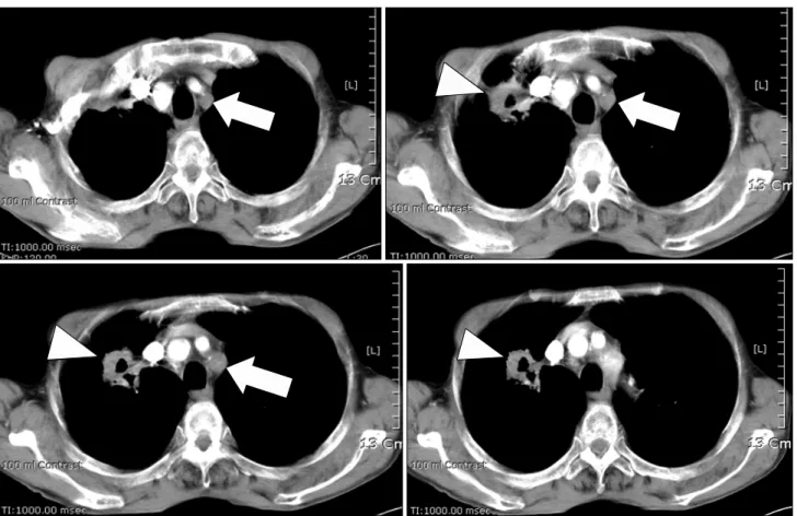 Fig.  3.  CT  -  Chest.  About  4  cm  sized  mass  with  central  cavitation  in  RUL  (arrow  heads)