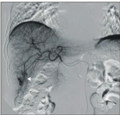 Fig. 1. Computerized Tomography shows a 3 cm enhanced  nodule (black arrow) in hepatic angle with small  gallbladder stone.