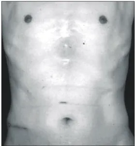 Fig. 4. Gross specimen shows a 3×2 cm nodular mass on the liver surface.