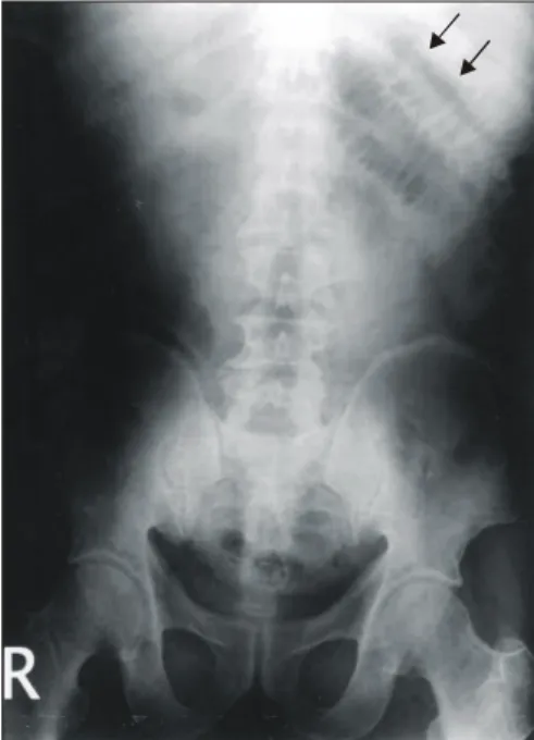 Fig. 1. Simple abdomen X-ray shows paralytic ileus on left  upper  quadrant.