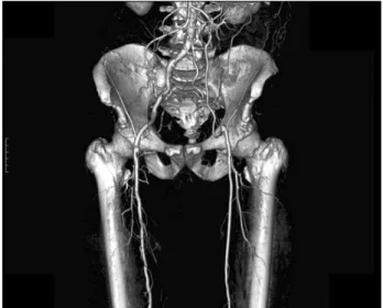 Fig.  2.  Preoperative  CT  angiography  shows  concentric  stenosis  of  lower  abdominal  aorta,  occlusion  of  left  common  iliac   ar-tery  and  external  iliac  arar-tery.