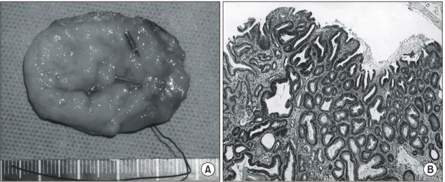 Fig. 3. (A) Preoperative endoscopic finding. There was a slightly hyperemic, depressed mucosal lesion with irregular margin in antrum of greater curvature side