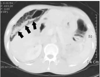 Fig.  3.  Operative  field.  (A)  Small  bowel  was  partially   obstruc-ted  because  of  mesenteric  volvulus