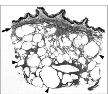 Fig.  4.  Microscopic  findings  (H&amp;E  stain).  The  cut  section  of  intes- intes-tine  shows  intact  mucosa  and  muscle  layer  (arrow)  and   nu-merous  bullae  in  the  subserosal  portion  (arrow  heads)  (×50).