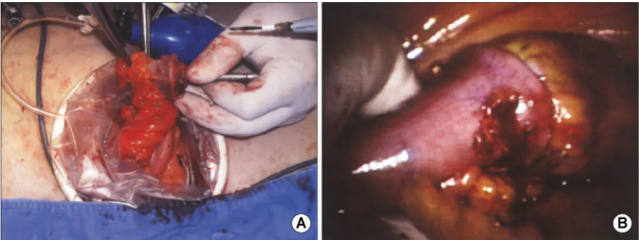 Fig. 2. (A) The inferior mesenteric vessel was high ligated by hand-assisted method. (B) Pelvic dissection