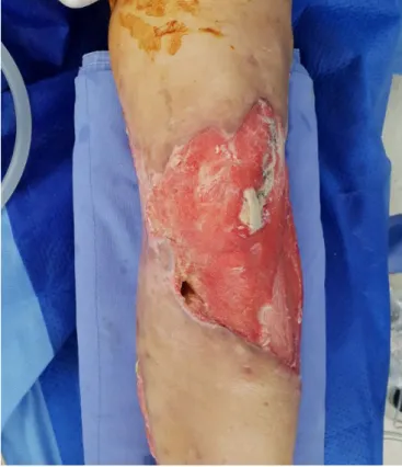 Fig. 1. A soft tissue (20.0 cm×15.0 cm) defects above the knee  following several debridement, with significant patella tendon  exposure on anterolateral side of the knee.