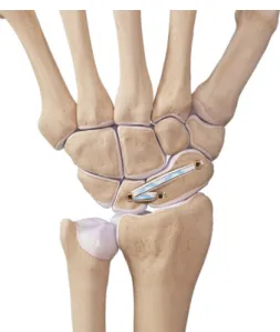 Fig. 8. All-dorsal scapholunate reconstruction with Internal Brace  ligament augmentation