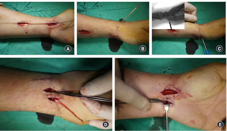 Fig. 1. (A) A half or 1/3 slip of flexor carpi radialis is harvested with a thin wire and sutured by whip stitch