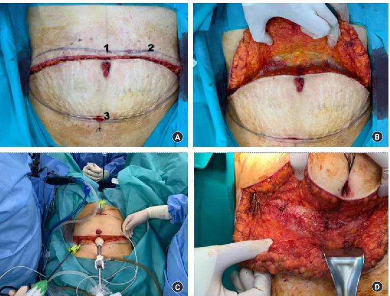 Fig. 2. (A) Port placement plan after dissection through external oblique fascia (1, main port for endoscopy; 2, left upper quadrant port; 