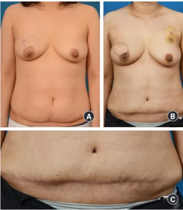 Fig. 3. Clinical photo of 45-year-old female patient received  simultaneous laparoscopic surgery with deep inferior epigastric  artery perforator flap: (A) preoperative, (B) postoperative 6  months, and (C) no additional scarring can be seen 6 months after