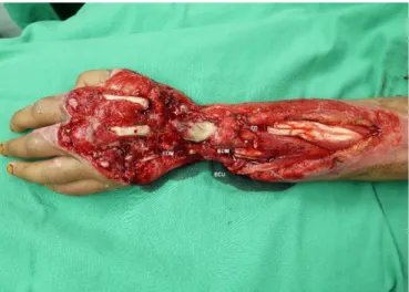 Fig. 2. Defects wound after debridement. ED, extensor digitorum; 