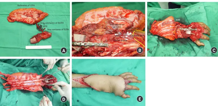 Fig. 4. Flap debulking and tenolysis surgery.