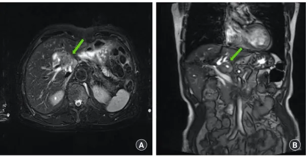 Fig. 1. Magnetic resonance imaging revealed a 2.5-cm sized mass (arrow) with delayed enhancement in the caudate lobe of the liver  abutting the portal vein, leading to suspicion of mass forming cholangiocarcinoma: (A) axial view and (B) coronal view.