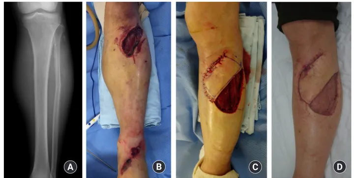 Fig. 1. (A, B) A 53-year-old male patient with open tibiofibular fracture involving proximal 1/3 of the left leg