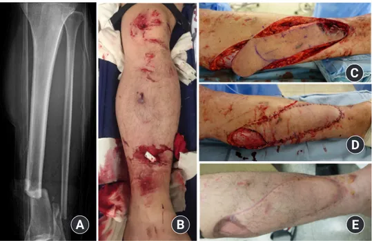 Fig. 5. A 28-year-old male patient presented following a motorcycle accident. (A, B) A foreign body was stuck in the fracture site