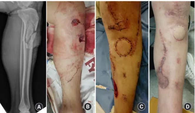 Fig. 6. (A, B) A 31-year-old male patient presented following a motorcycle accident with left tibiofibular open fracture