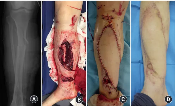 Fig. 7. (A, B) Clinical case of a 58-year-old man with right tibiofibular open fracture caused by a motor vehicle accident