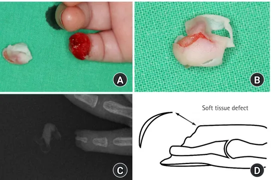Fig. 2. Subcutaneous island flap based on distal transverse palmar  arch was elevated.