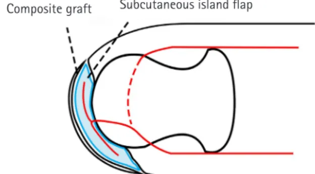 Fig. 4. A composite graft was done over subcutaneous island flap  with amputee.