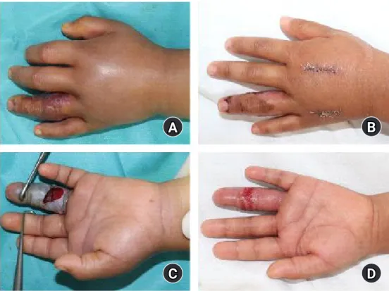 Fig. 1. (A, B) Preoperative finding. Moderate swelling and skin necrosis were observed