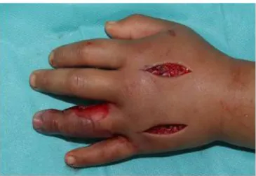 Fig. 3. The image of topical oxygen therapy. Wound was sealed  with aseptic fluid bag which can be connected with an oxygen  cannula