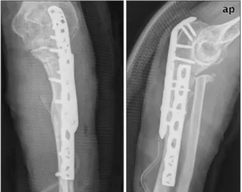Fig. 4.  For stress fractures of the olecranon, a long locking  compression plate was added and fixed to the end of the  olecranon.