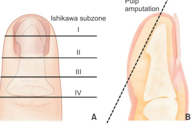 Fig.  1.  (A) Level of fingertip amputation according to the  Ishikawa classification