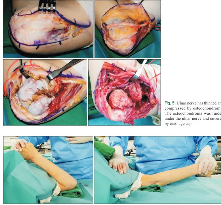 Fig. 5.  Ulnar nerve has thinned and  compressed by osteochondroma. 