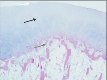 Fig.  7.  Histological section of an osteochondroma showing  the three layers. White arrow: perichondrium, black arrow: 