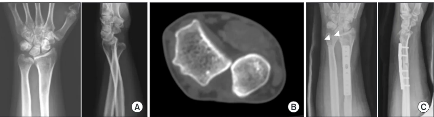 Fig. 1.  (A) Preoperative wrist posteroanterior and lateral radiographs of a 24-year-old woman showed distal radioulnar joint  subluxation associated with radial malunion