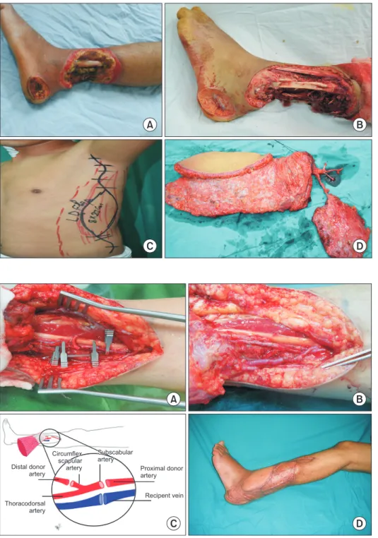 Fig. 2.  A case of free tissue trans- trans-fer for left leg. A patient who was  reconstructed by chimeric flap  flow-through technique for coverage  of posttraumatic soft tissue loss  of the lower third of the left leg