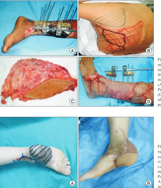 Fig.  4.  A case of heel reconst- reconst-ruction. A patient with unstable,  adherent scar overlying the  right heel