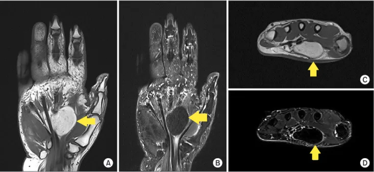 Fig. 2.  (A) Intra-operative view of the the median nerve and adherent mass were identified