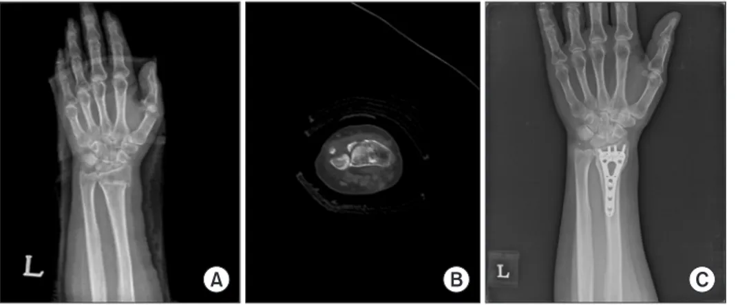 Fig.  3.  (A, B) In intra-articular  fractures with sigmoid notch  involvement, (C) distal fragment  that involved sigmoid notch could  be fixed more stably by varying  the angle of the ulnar-most screw.