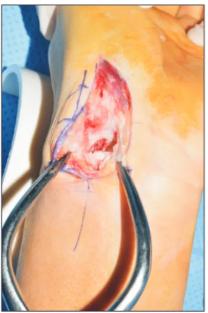 Fig. 2.  Reduction and temporary K-wire fixation then wedge  structural bone graft is inserted.