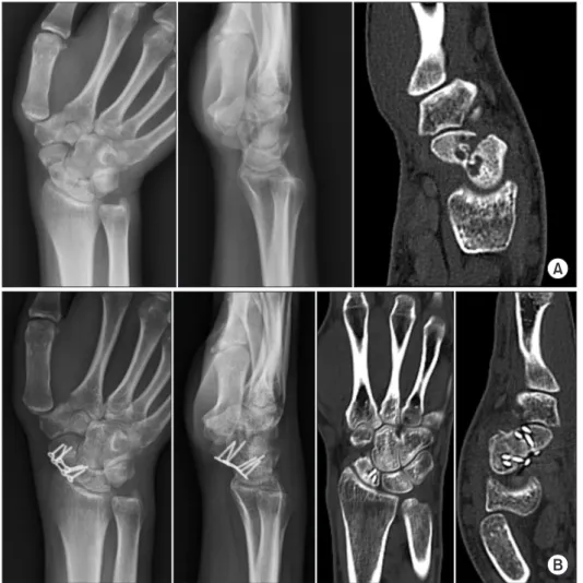 Fig.  5.  Representative case of  a scaphoid waist nonunion in a  20-year-old patient with  hump-back deformity