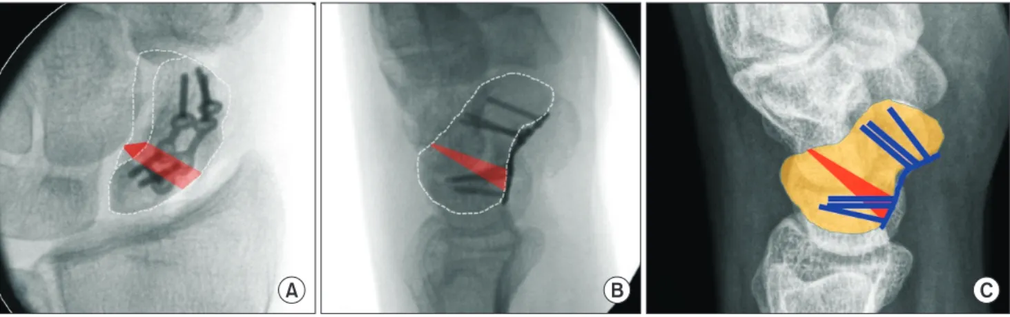 Fig.  7.  Proximal scaphoid watershed line (PSWL) is the  point at which the nonarticulating portion of scaphoid  bone  becomes articulating.