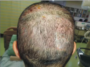 Fig. 4.  Thick skin graft with a histological thickness of 0.035  inches harvested at an incorrect depth setting (H&amp;E, ×40).