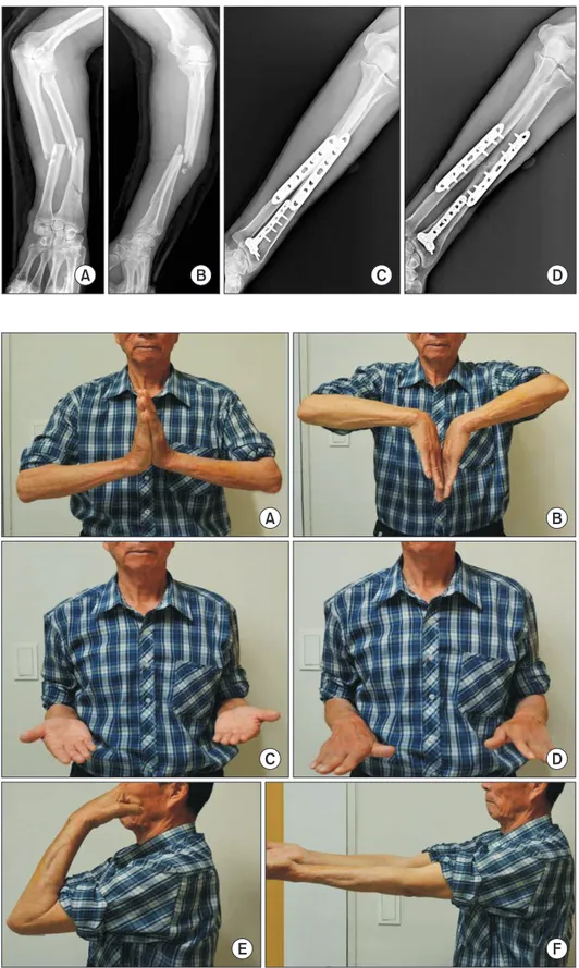 Fig.	4.  (A-F) Range of motion of  wrist and elbow at postoperative  12 months.