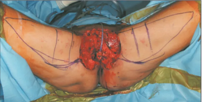 Fig.	 1.  Both sides of the vulvar defect; preparation of the  medial thigh V-Y advancement flap