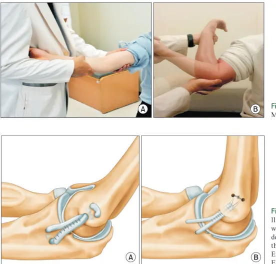 Fig.	 4.  Schematic of medial co- co-llateral ligament reconstruction  with figure of 8 technique (A) and  docking technique (B)