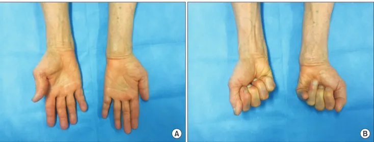 Fig.	1.  Clinical photographs showing volar swelling of left wrist (A) and limitation of active flexion of the left fourth and fifth  fingers (B).